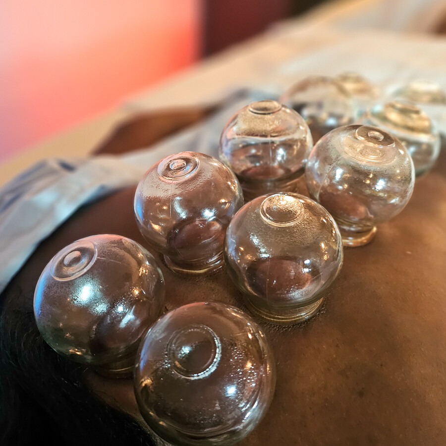 Cupping Therapy at Metro Acupuncture in Atlanta