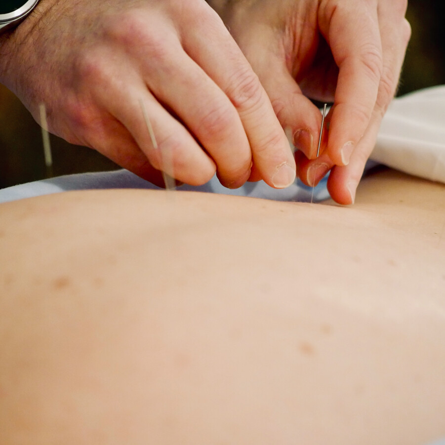 Acupuncture for Low back pain at our Atlanta Acupuncture Clinic in Sandy Springs/Atlanta