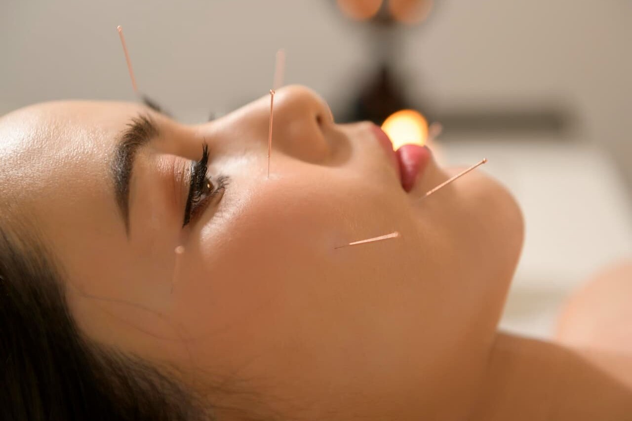 Thumbnail-For-Woman-Receiving-Cosmetic-Acupuncture-By-Metro Acupuncture