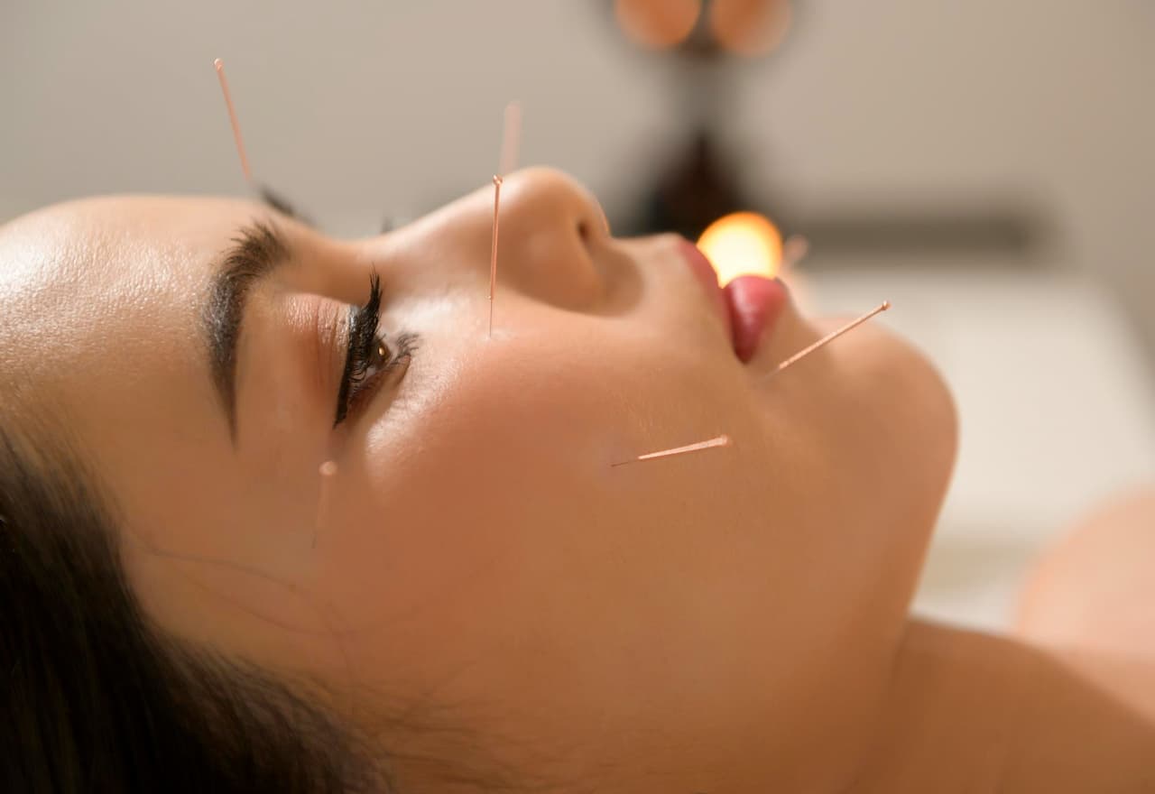 Thumbnail-For-Woman-Receiving-Cosmetic-Acupuncture-By-Metro Acupuncture